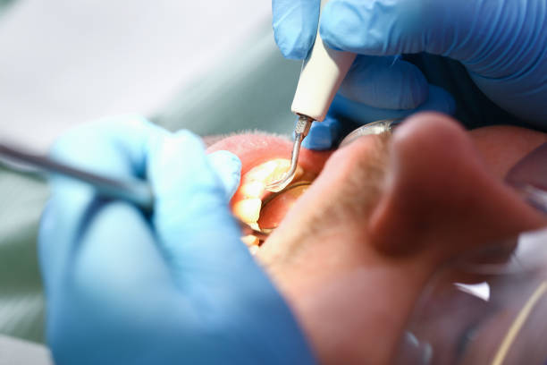 Best Emergency Wisdom Tooth Extraction in Cheswick, PA
